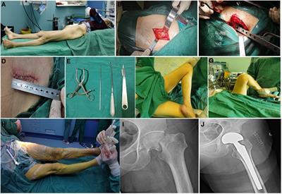 Outcomes of direct superior approach and posterolateral approach for hemiarthroplasty in the treatment of elderly patients with displaced femoral neck fractures: A comparative study